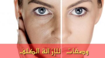 وصفات طبيعية للتخلص من الكلف بشكل نهائي والتمتع ببشرة صافية