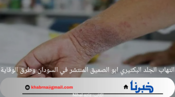 التهاب الجلد البكتيري ابو الصميق المنتشر في السودان وطرق الوقاية