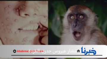 الاخذ بالاحطياطات لوقف انتشار فيروس جدري القردة