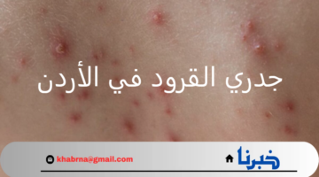 هل أنتشر جدري القرود في الأردن وهل يشكل تهديدًا للصحة العامة؟