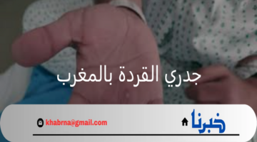 رصد خمس حالات واردة من جدري القردة بالمغرب 2024 والسلطات الصحية مستعدة