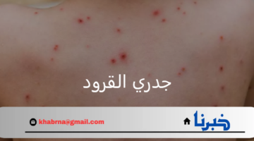 وارة الصحة.. تحسم الجدل القائم حول العلاقة بين جدري القرود والجدري المائي