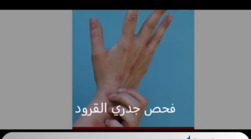 وزارة الصحة العراقية تنفي تسجيل أو فحص جدري القرود في كافة المحافظات حتى الآن