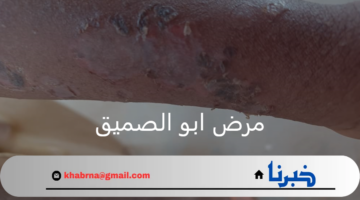 وزارة الصحة السودانية.. تعلن انتشار مرض ابو الصميق في الولاية الشمالية للبلاد
