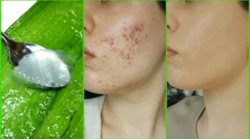 "وشك هينور بالوصفة دي".. كيفية تحضير غسول الصبار لتنظيف الوجه بشكل يومي والقضاء على البثور والروؤس السوداء