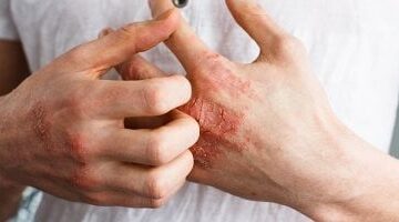 الرياضة والهدوء النفسي تخفف أعراض هذا المرض الجلدي