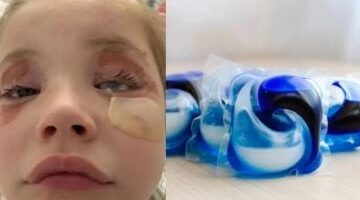 فاجعة أسترالية: طفلة تخسر جزءًا من بصرها بعد انفجار كبسولة غسيل في عينيها