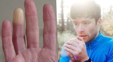 ما متلازمة رينود المسببة لزرقة الأطراف.. أشهر الأعراض وطرق العلاج